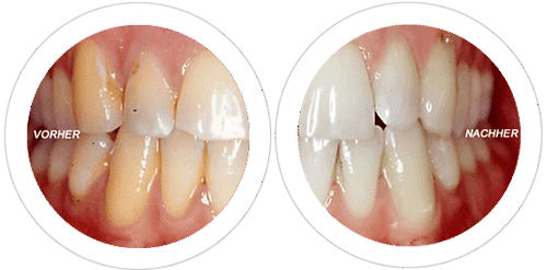 Zähne vor und nach einer Bleaching-Behandlung im Vergleich